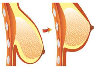 لیفت سینه (mammapexy ٬ breast lifting )