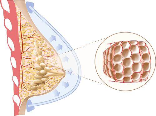 تزریق چربی سینه / کاربرد تزریق چربی سینه