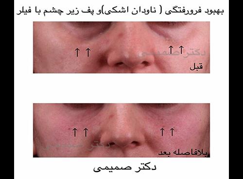 تزریق ژل زیر چشم