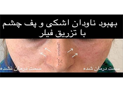 تزریق فیلر زیر چشم