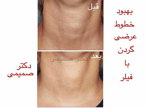 درمان خطوط گردن با فیلر