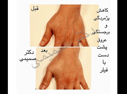 تزریق فیلر(ژل) دست