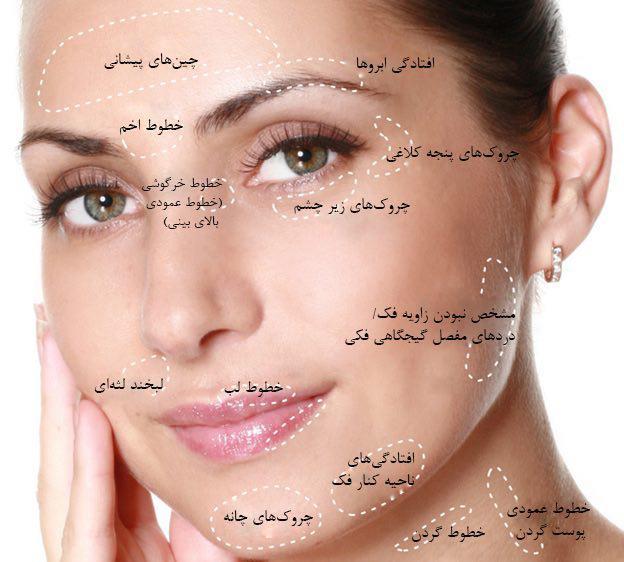 نواحی تزریق بوتاکس در صورت