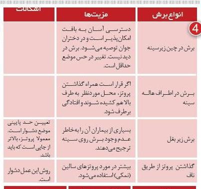 برش ها در پروتز سینه