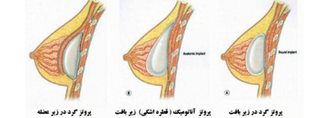 محل قرار گرفتن پروتز نسبت به بافت