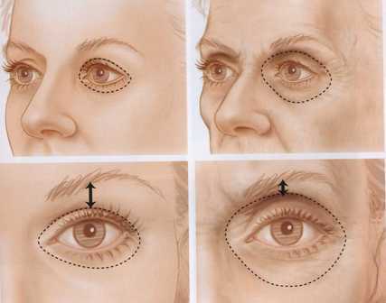 اثرات تحلیل چربی طبیعی دور چشم